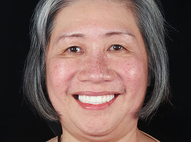 Patient (after dental implants) 