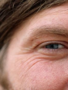 The Aesthetic Medic eye rejuvenation treatments crows feet