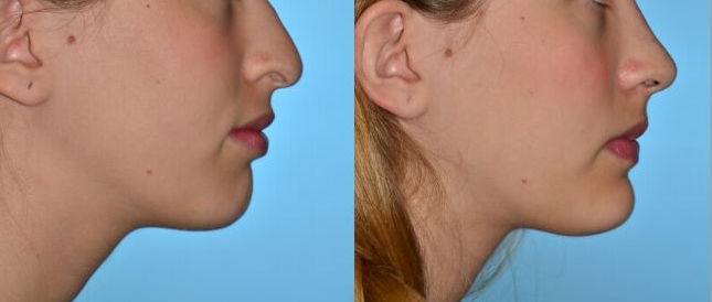 Mentoplastia1