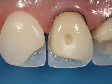 Durability and Care Tips Teeth