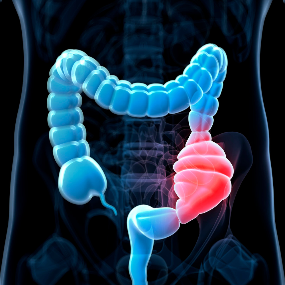 representação gráfica da constipação intestinal