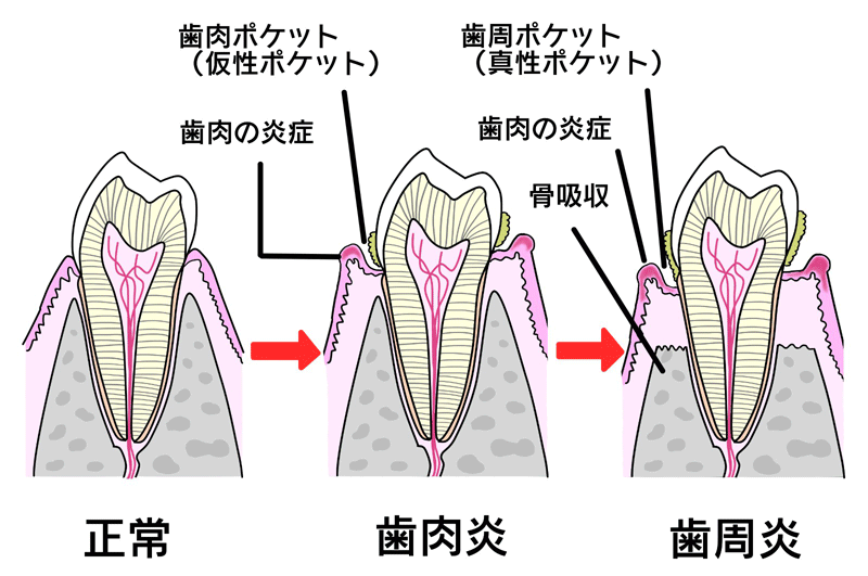 歯周病治療