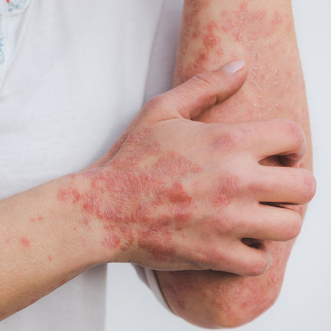 Leidest du unter einer Autoimmunerkrankung? 