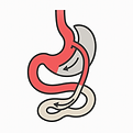 mini_gastric_bypass.png