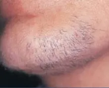 Best Laser Hair Removal In Melbourne Dermacare Dermacare