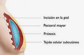 Dr Martin Gaston Alvarez Cirujano Plástico experto en aumentos de pectorales en Barcelona