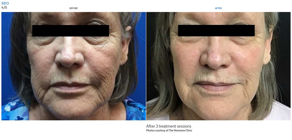 XEO - Before After 3