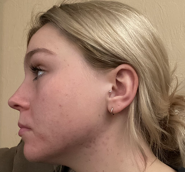 Perfectly Bare Laser -  See active Acne treatment results from DyeVL