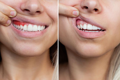 comparison-young-woman-with-red-bleeding-gums-health-gums-before-after-treatment