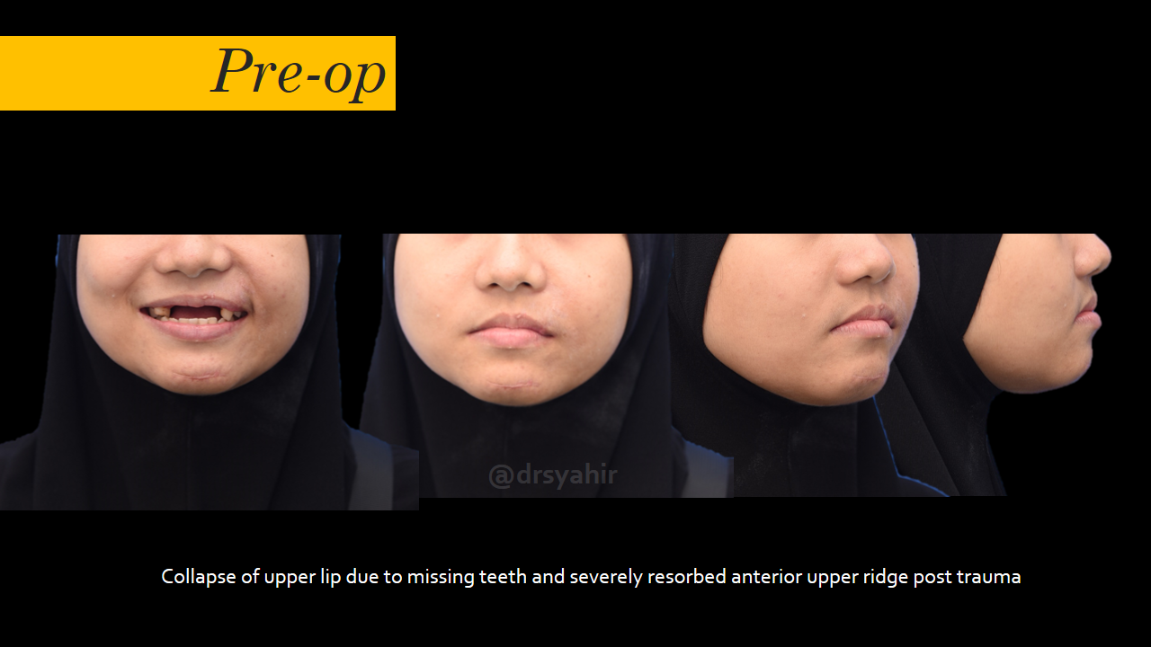 Alveolar bone augmentation using autogenous cortical plates and simultaneous dental implants placement in severely resorbed anterior ridge. content media