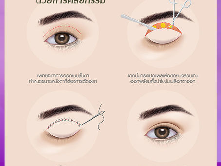 เสริมสวยตาสองชั้น ด้วยการศัลยกรรม