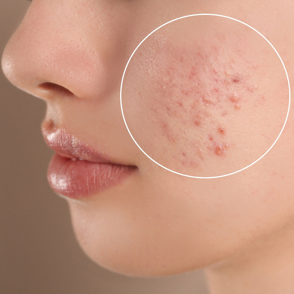 Skin with acne marks