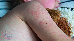 Child with measles rash on arm and face during 2025 Tshwane outbreak – Mums & Bums Clinic South Africa