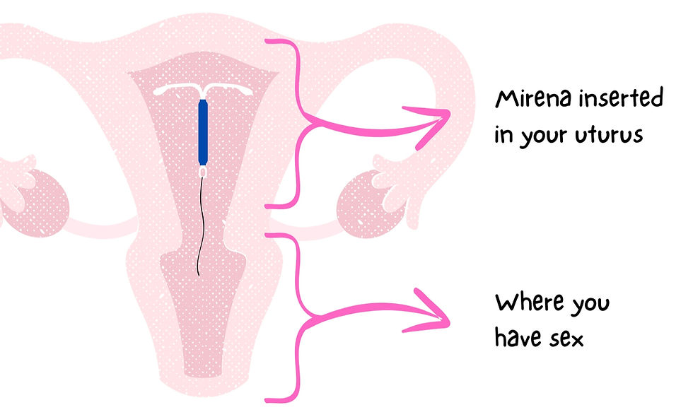 A uterus showing the placement of the Mirena