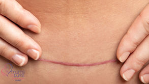 A healed c-section wound.