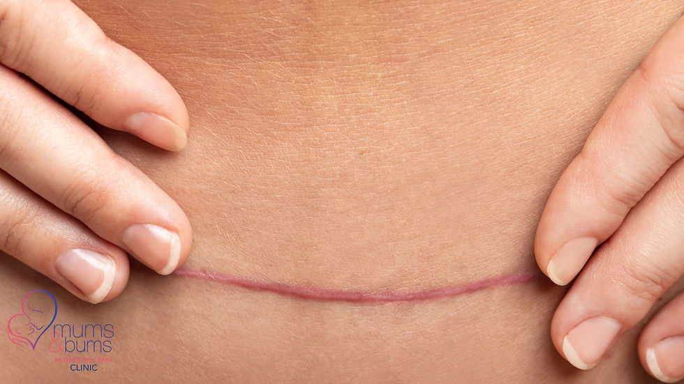 A healed c-section scar.