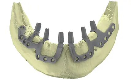 Subperiosteal implant 