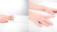 Mirror Therapy for Phantom Limb Pain and Stroke