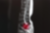 Spondylolisthesis