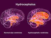 CME: Normal Pressure Hydrocephalus - The Paradox of "Normal" Pressure