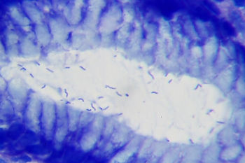 Helicobacter pylori seen in stomach biopsy from a gastritis patient