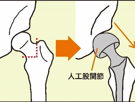 【コラム17】人間は非対称である~脚長差~
