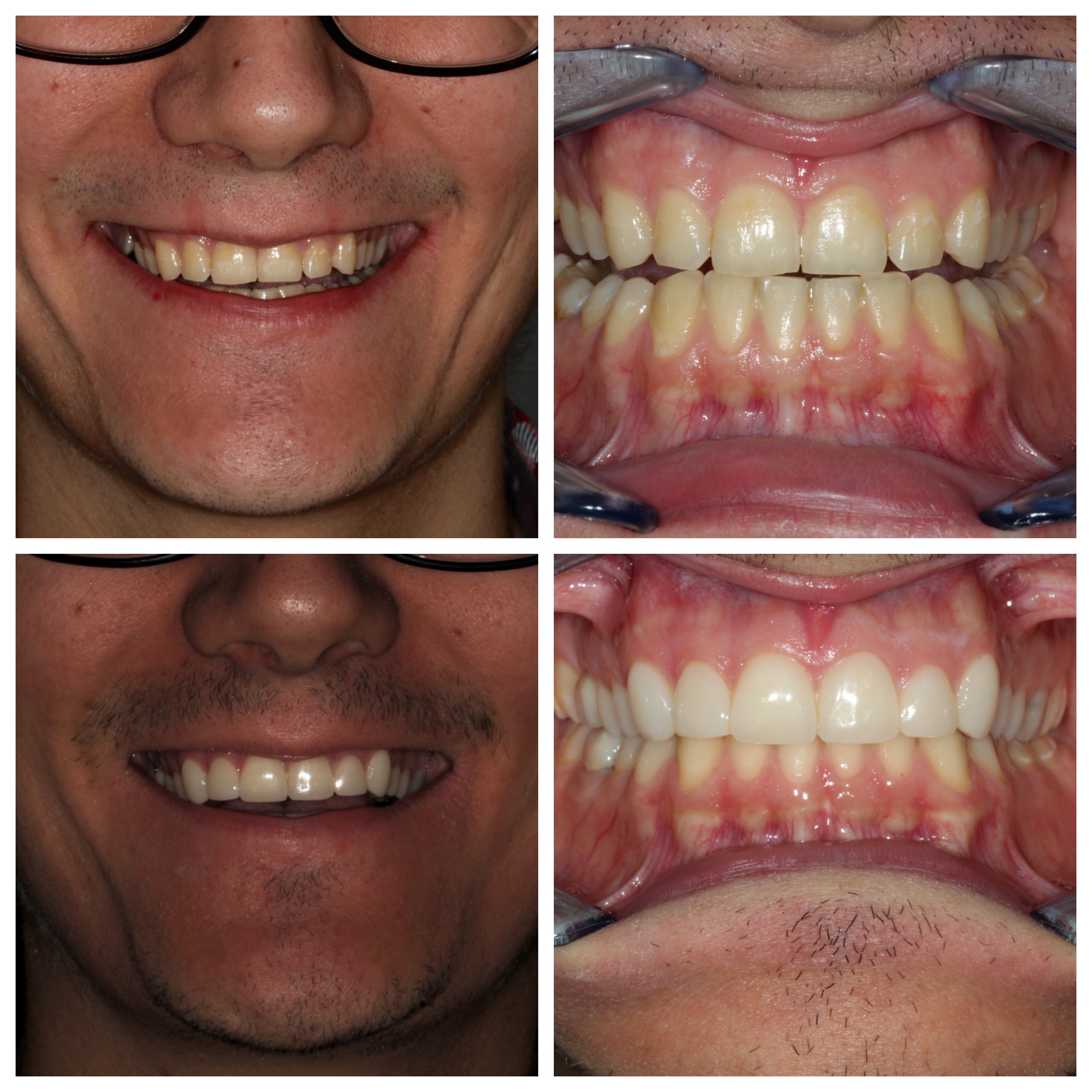 Composiet veneers