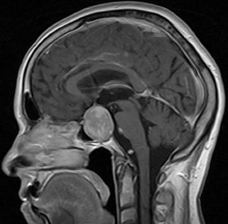 Imagem disponível em <http://pictures.doccheck.com/com/photo/4601-hypophyseal-adenoma> acesso em 18/07/2016.