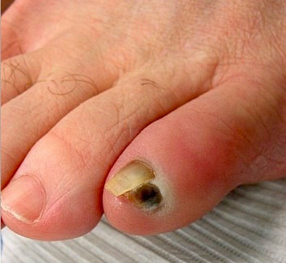 Dr. Weiss’s Summer Series on Preventative Care For Your Feet Part 1