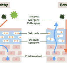 Why Eczema Occurs and How We Can Treat it