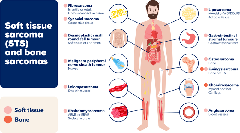 Figure 1. Types of bone and soft tissue sarcomas arising in various areas of the human body. Diagram from MedStar Health (2025).