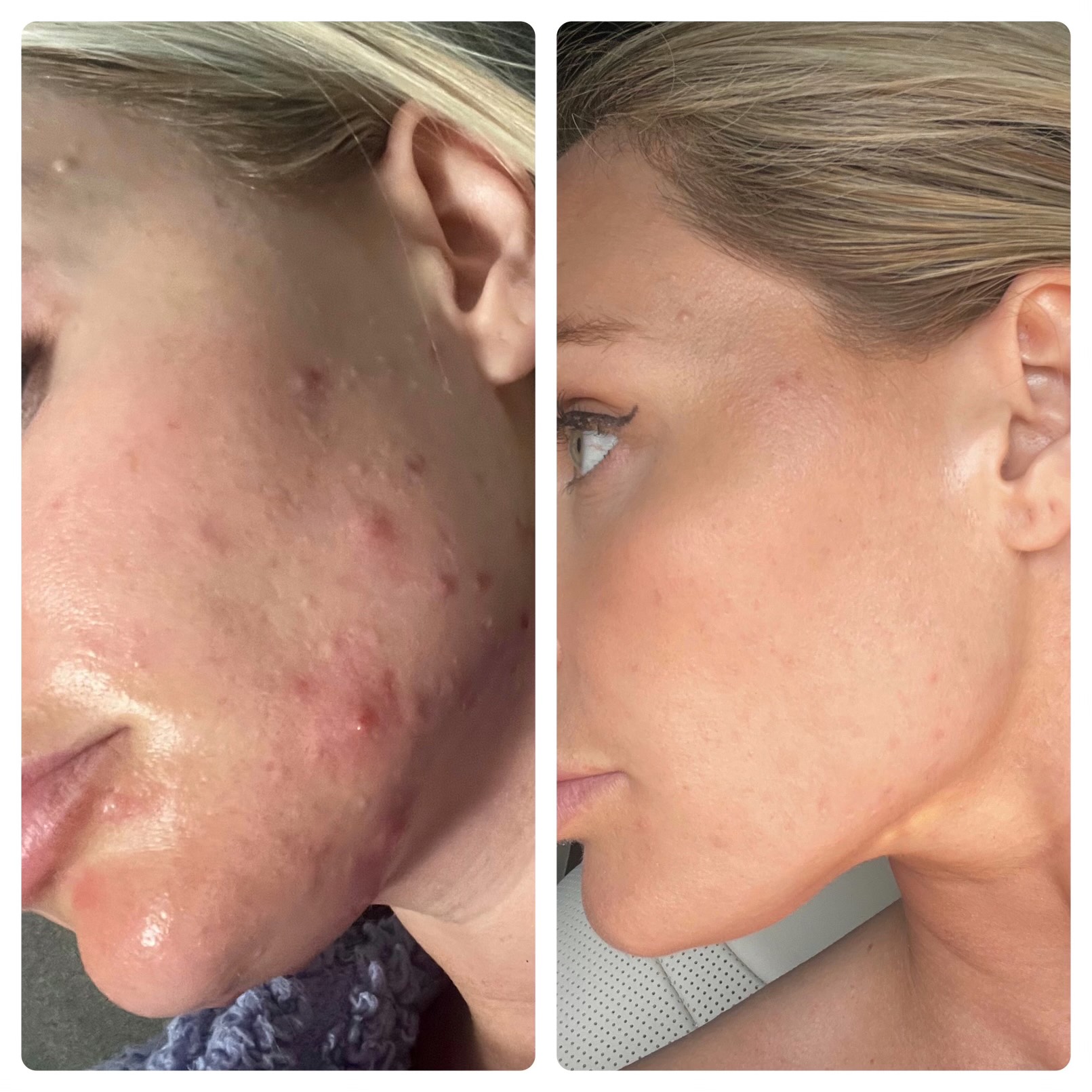 Before and after photo of a Kennedy Skincare client treated for psoriasis in Newport Beach