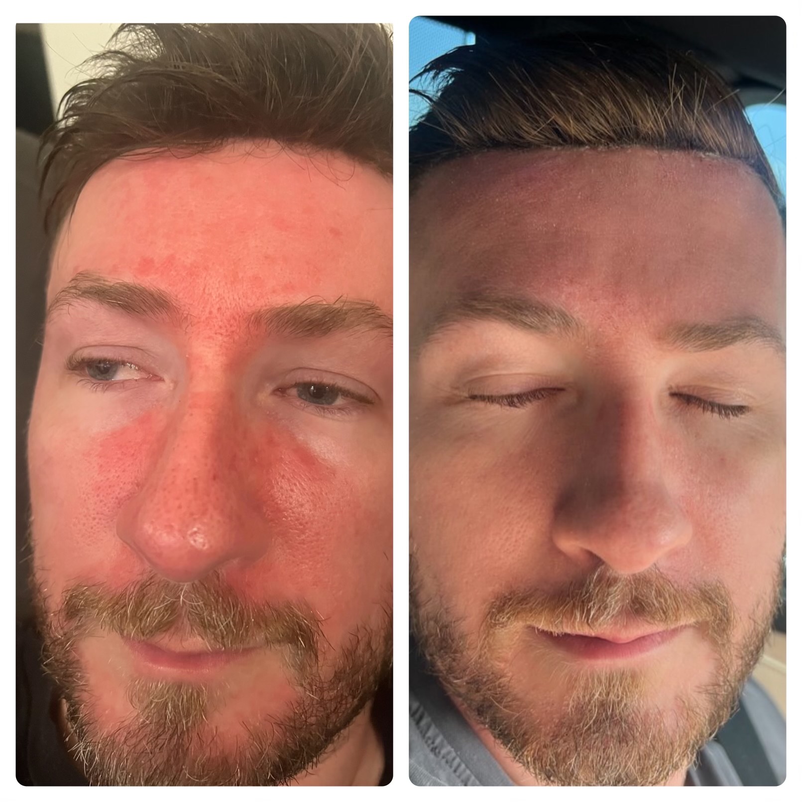 Before and after anti-aging facial transformation at Kennedy Skincare Newport Beach