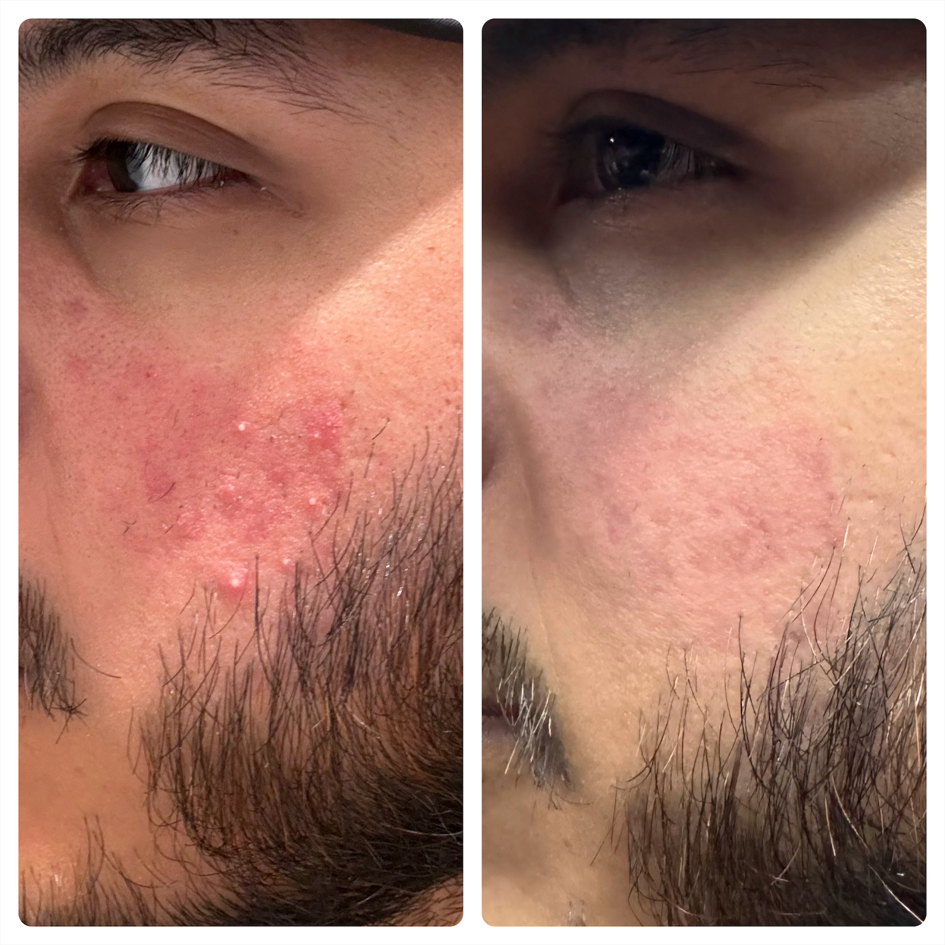 Before and after rosacea treatment results from Kennedy Skincare Newport Beach