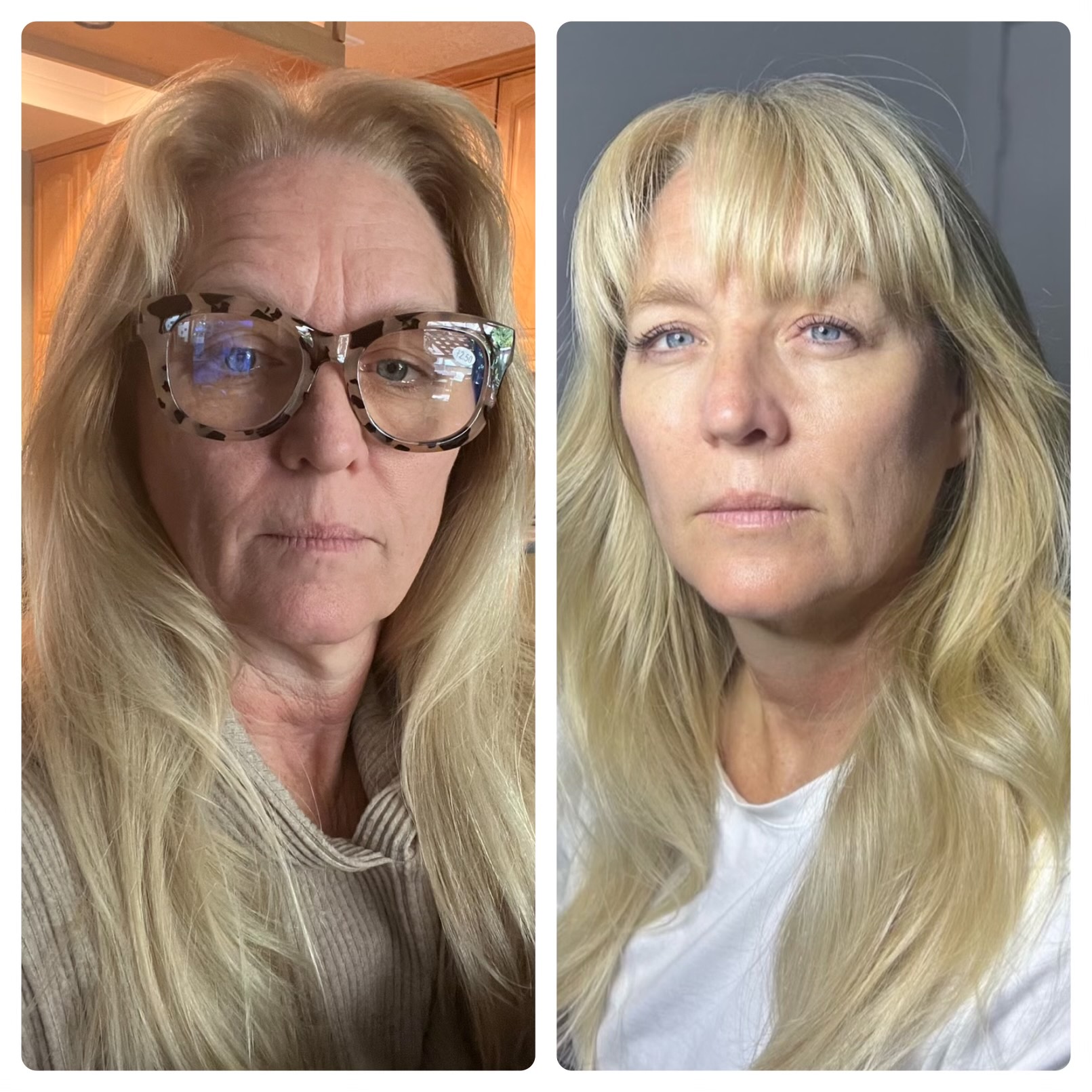 Before and after photo of a Kennedy Skincare client with adult acne in Newport Beach, CA