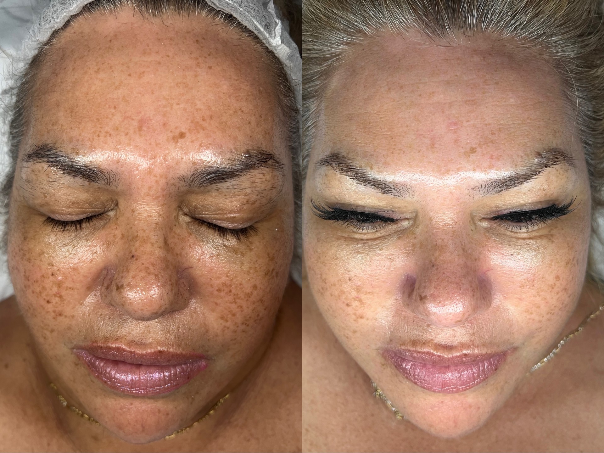 Before and after hyperpigmentation correction by Kennedy Skincare in Newport Beach