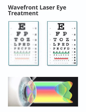 wavefront-laser-eye-treatment.jpg