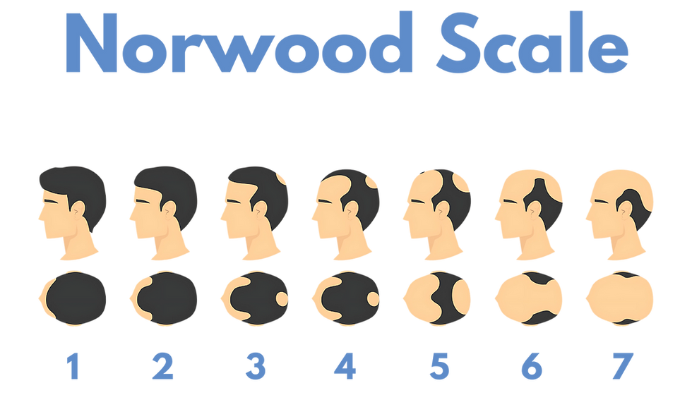 Norwood scale showing levels of hair loss