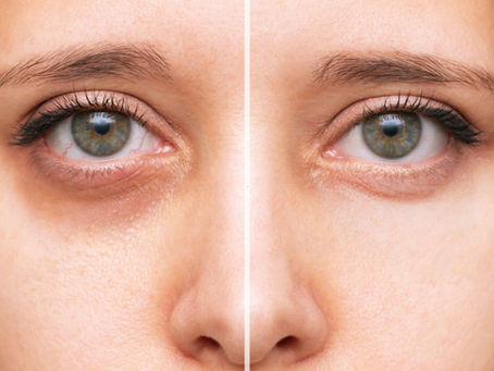 Undereye Filler Near Me: What to Know Before You Set Up Your Appointment