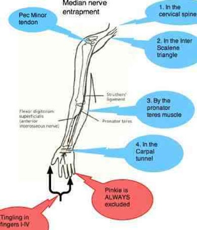 Median-nerve-entrapment-sites.jpg