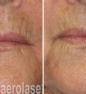 Melasma1 - Pair.png