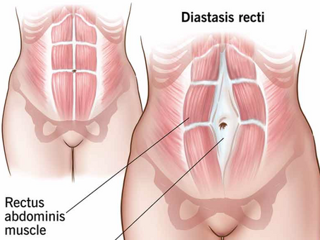 Diastasis Recti After Pregnancy: Symptoms, Recovery & Safe Exercises