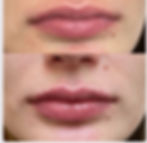 lip fillers near me, lip injections Snellville, Retsylane Snellville GA,