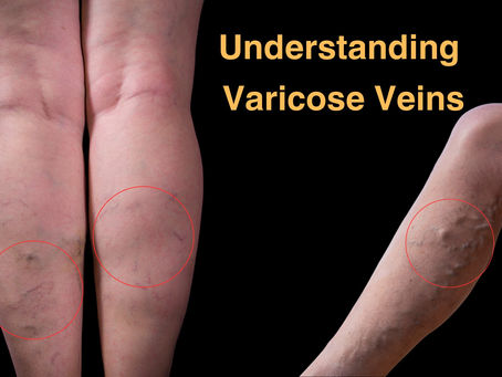 Understanding Varicose Veins: Causes, Treatment, and Recommendations for a Healthier You