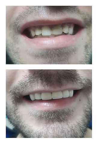Couronnes dentaires à Belgrade Corone dentali a Belgrado Dental crowns serbia
