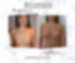 Breast Augmentation Belgrade Augmentation Mammaire Aumento del Seno