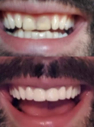 Couronnes dentaires à Belgrade Corone dentali a Belgrado Dental crowns serbia