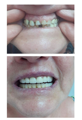 Couronnes dentaires à Belgrade Corone dentali a Belgrado Dental crowns serbia