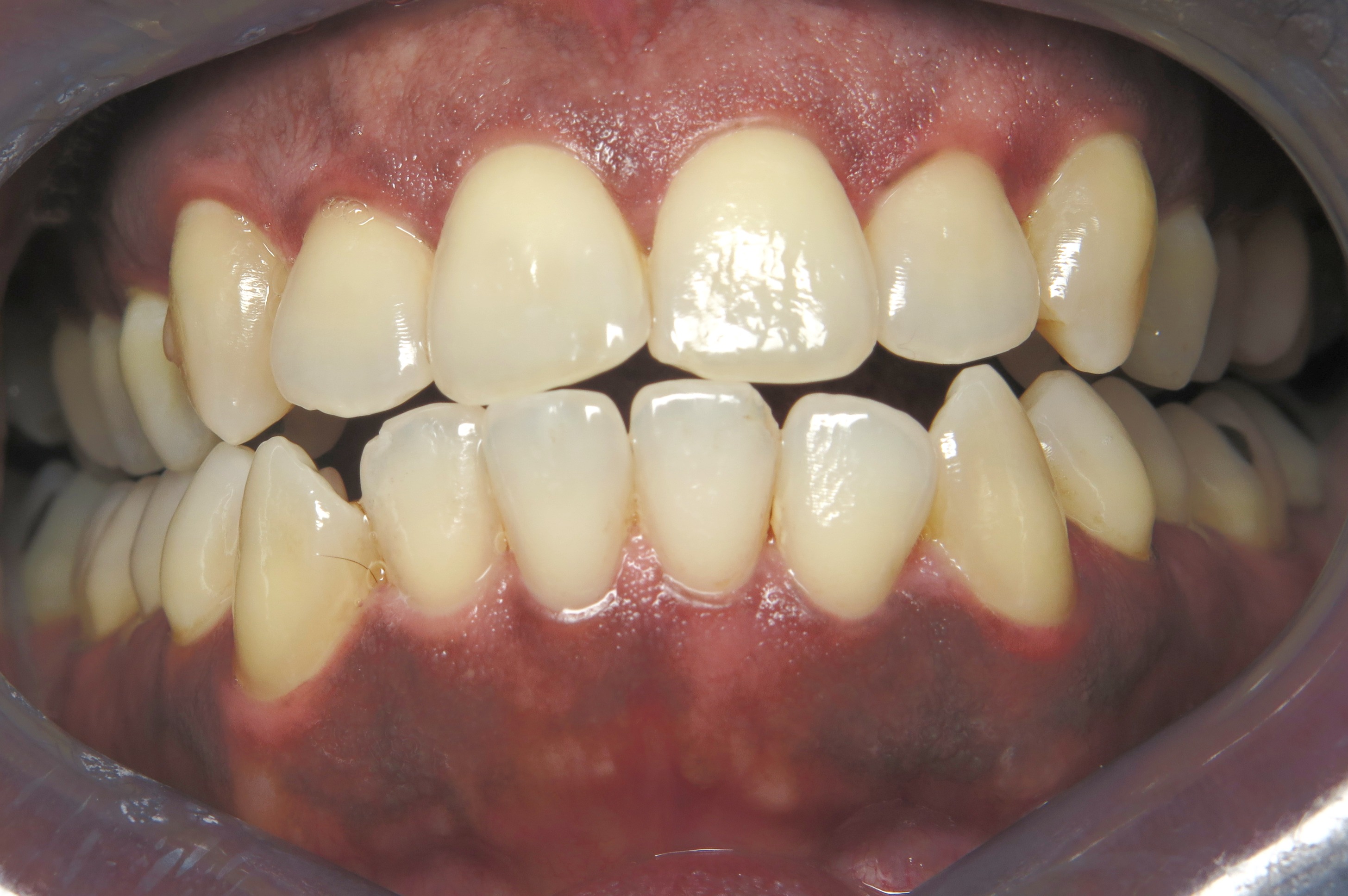 Myofunctional TherapistWestchestermyofunctional therapy