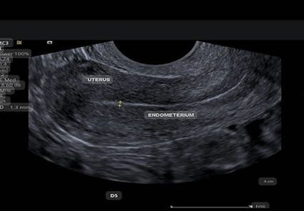 Transabdominal pelvic scan